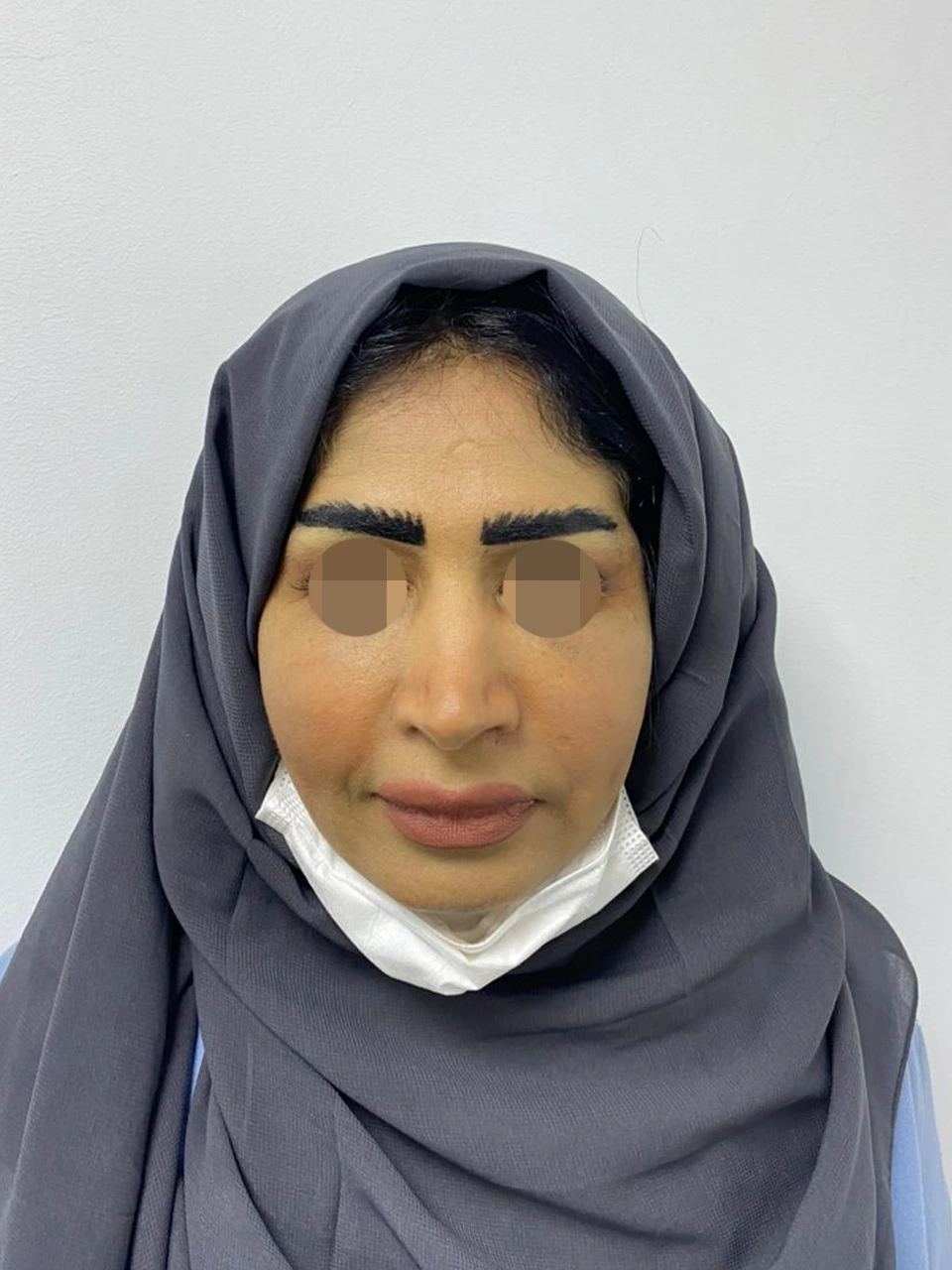 Facial Fat Injection — after