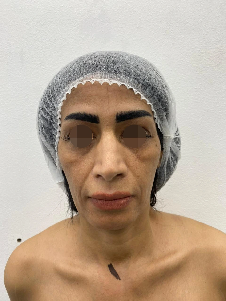 Facial Fat Injection — before