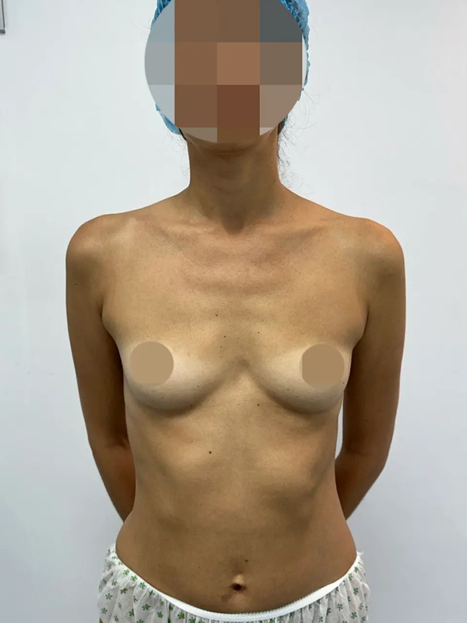 Breast Surgery — before