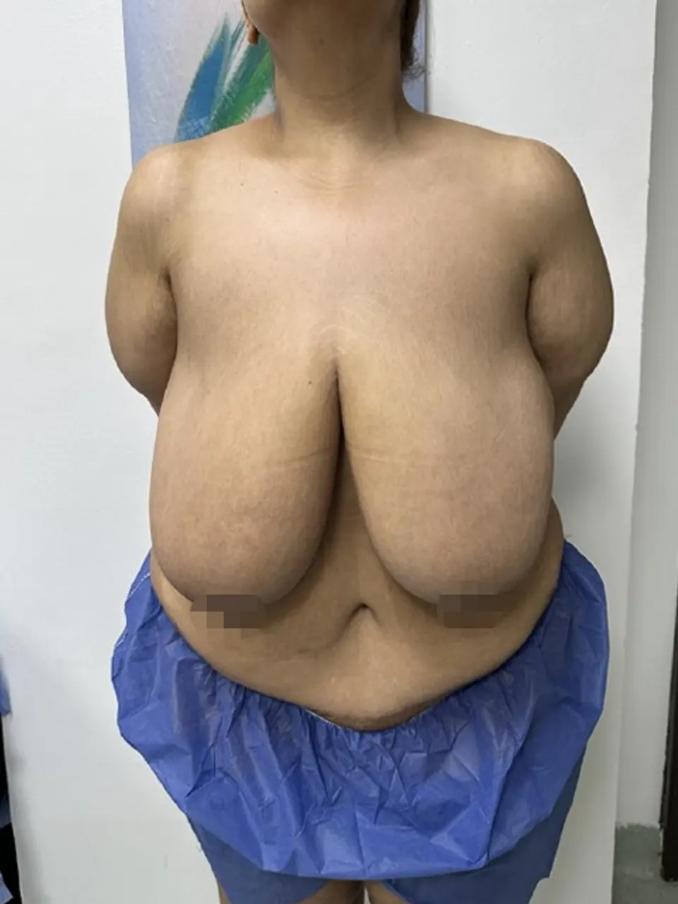 breast reduction  — before