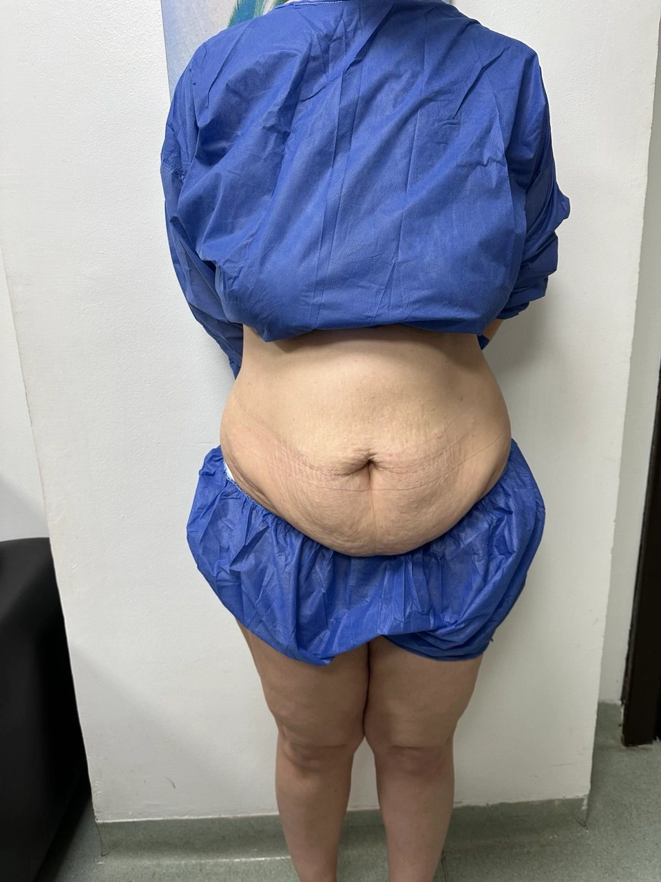 High-Definition Tummy Tuck — before