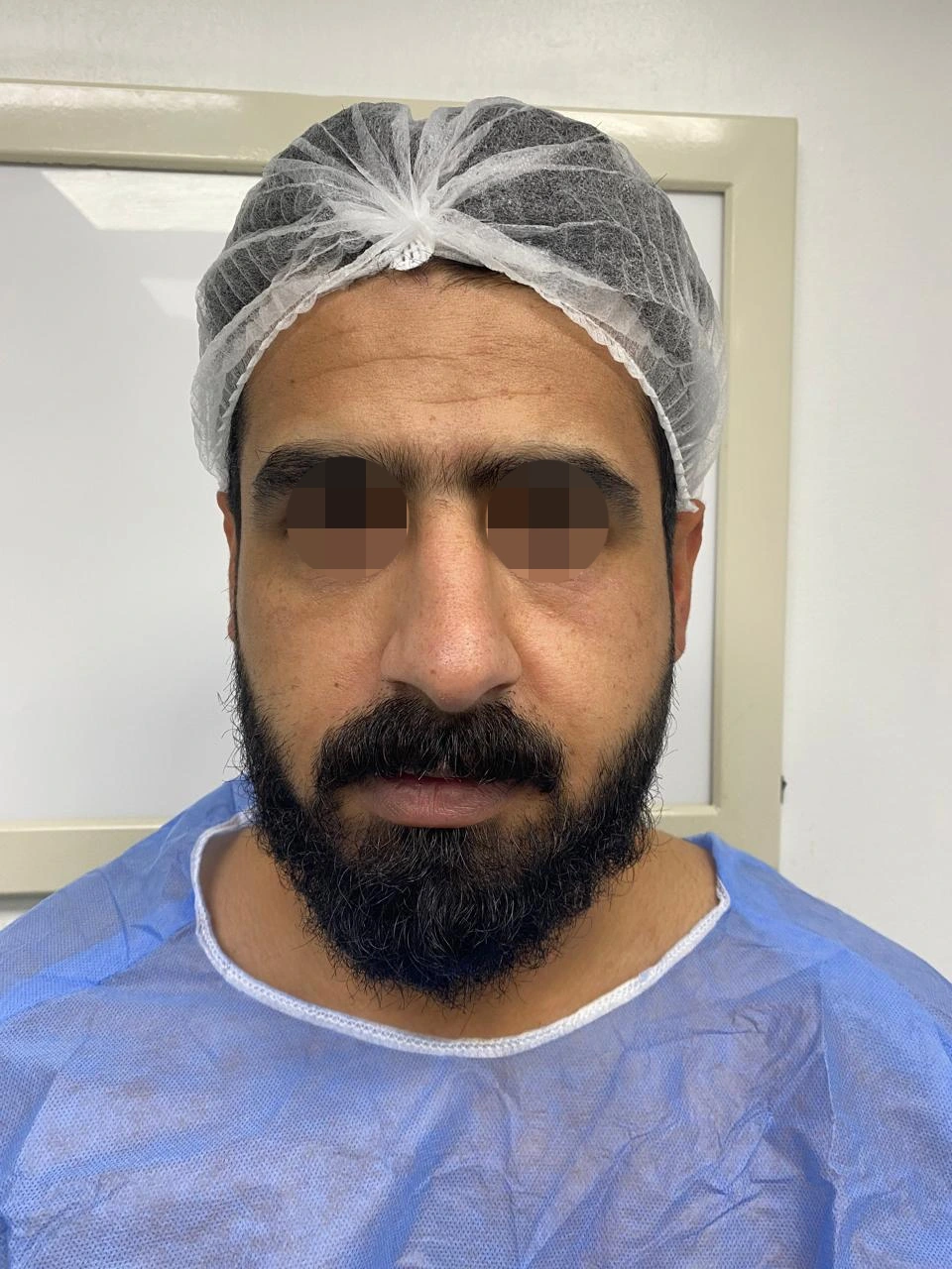 Rhinoplasty — before