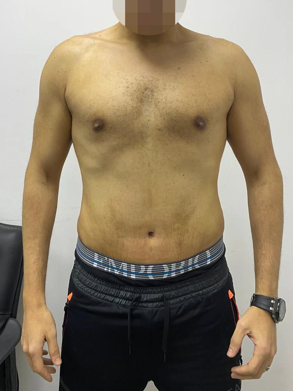 Tummy Tuck — after